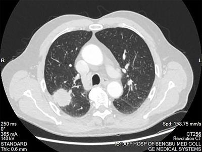 Treatment, pathological characteristics, and prognosis of pulmonary inflammatory myofibroblastic tumor–a retrospective study of 8 cases